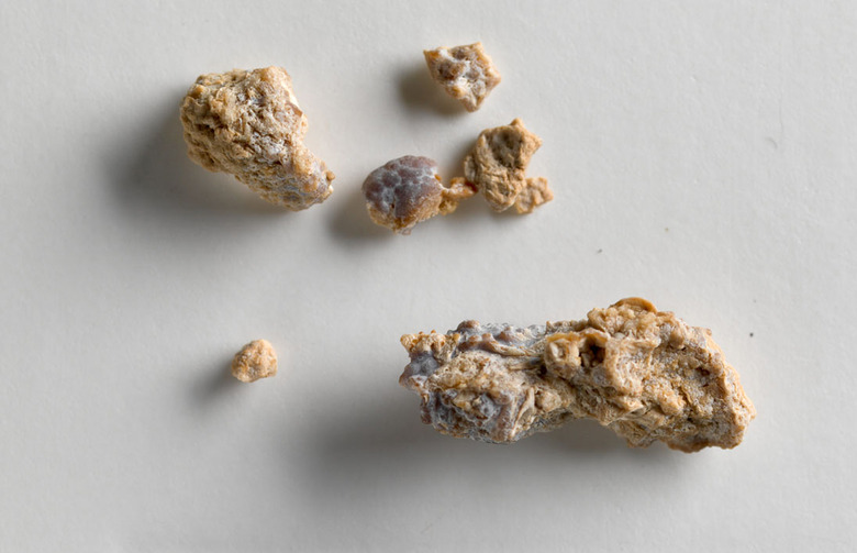 A Decrease in Kidney Stones