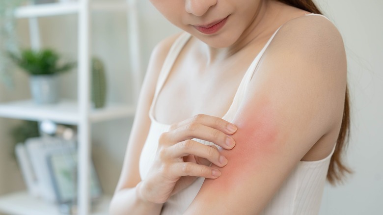 woman having allergic reaction on arm