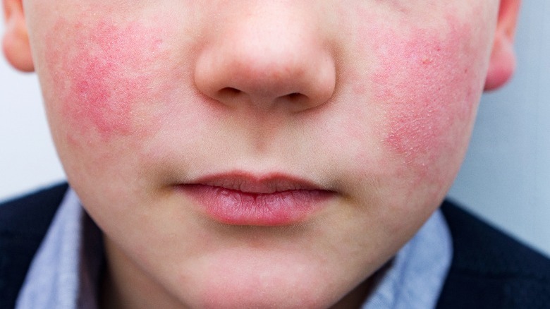 Young boy with allergic reaction on face