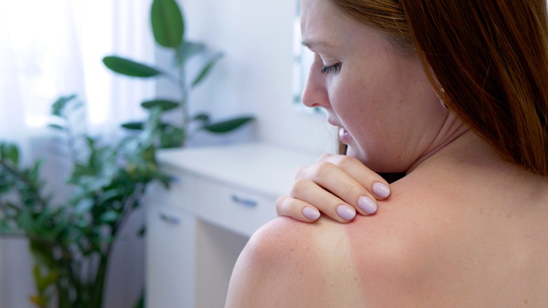 woman with sunburn shoulder