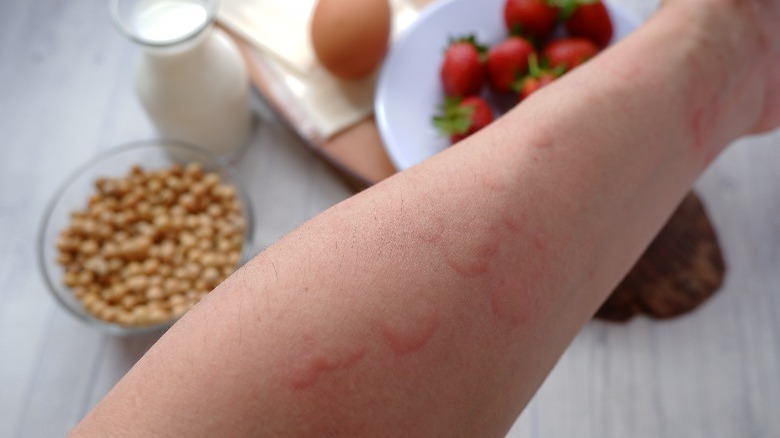 Allergic rash on arm