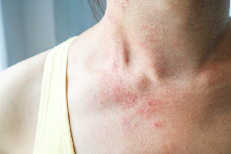 Skin rash