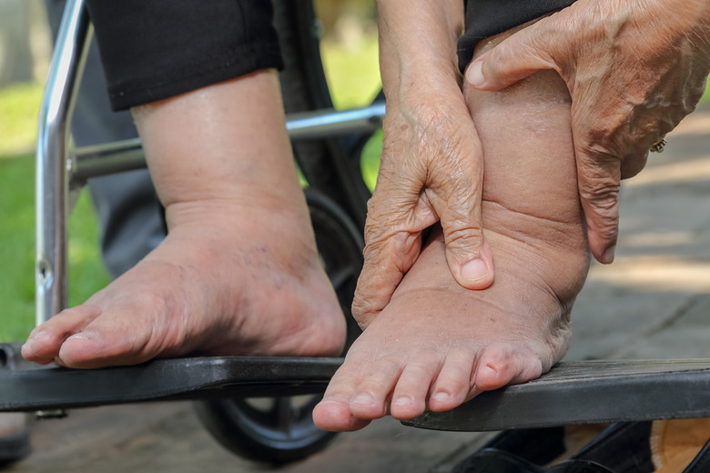 Swelling in feet