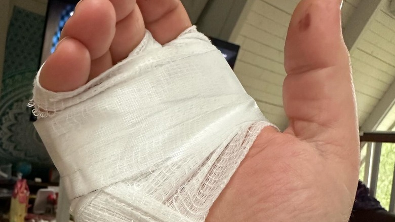 Closeup of Goldman's injured hand