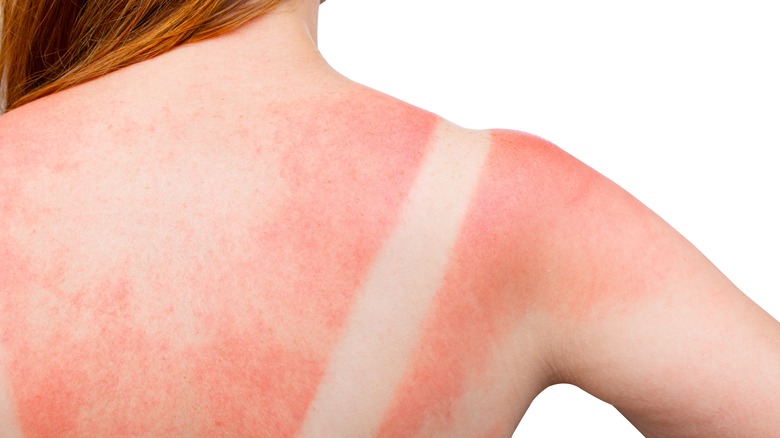 Woman with sunburn